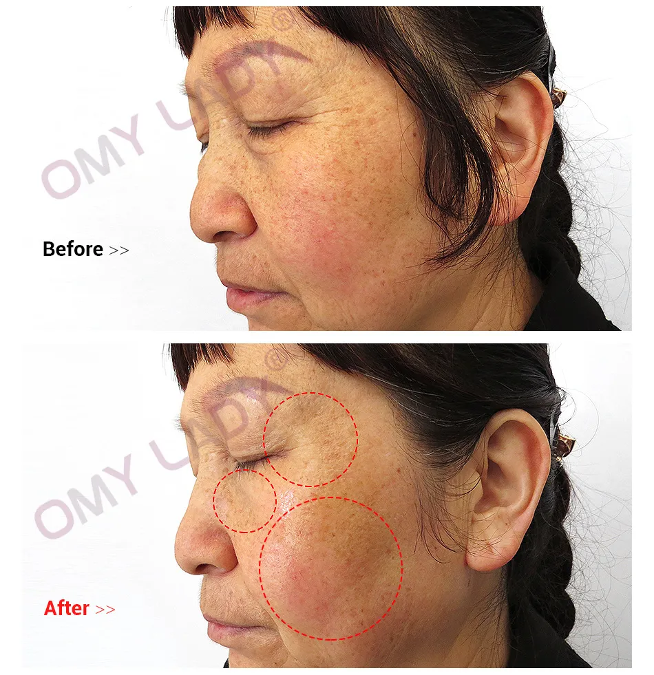 Collagen Silk Pompoms Rejuvenate, Tighten and Shrink Pores Suit