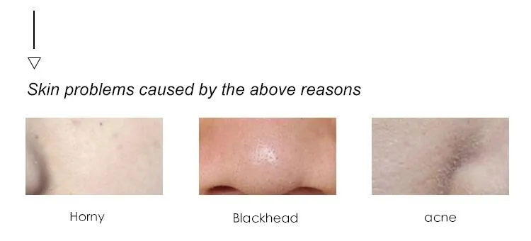 Facial Pore Cleaner Skin Tightening Suction Device Portable Vacuum Blackhead Remover